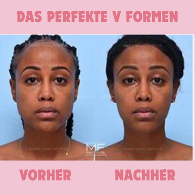 SlimSuction™ Defined Jawline Boost