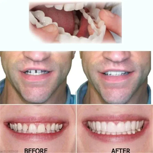 InstaDent™ Reusable Smile Solution