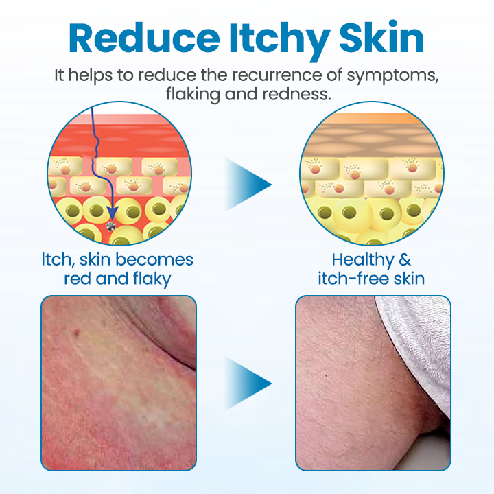 1+1 Free | ItchAway™ Instant Skin Comfort