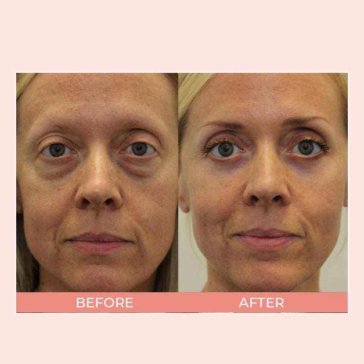 WrinkleAway™ Reduces Fine Lines