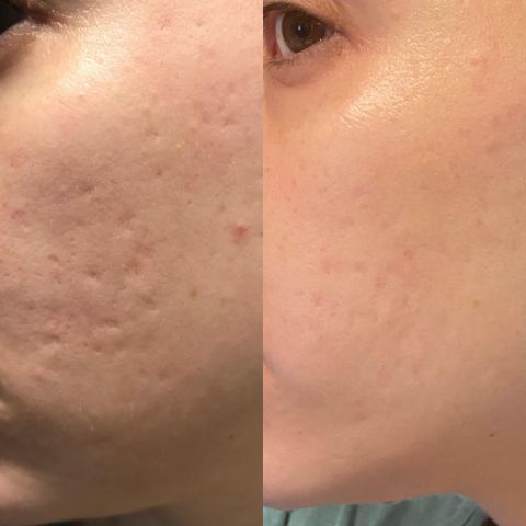 2+2 Free | SmoothPatch™ Wrinkle-Free Confidence