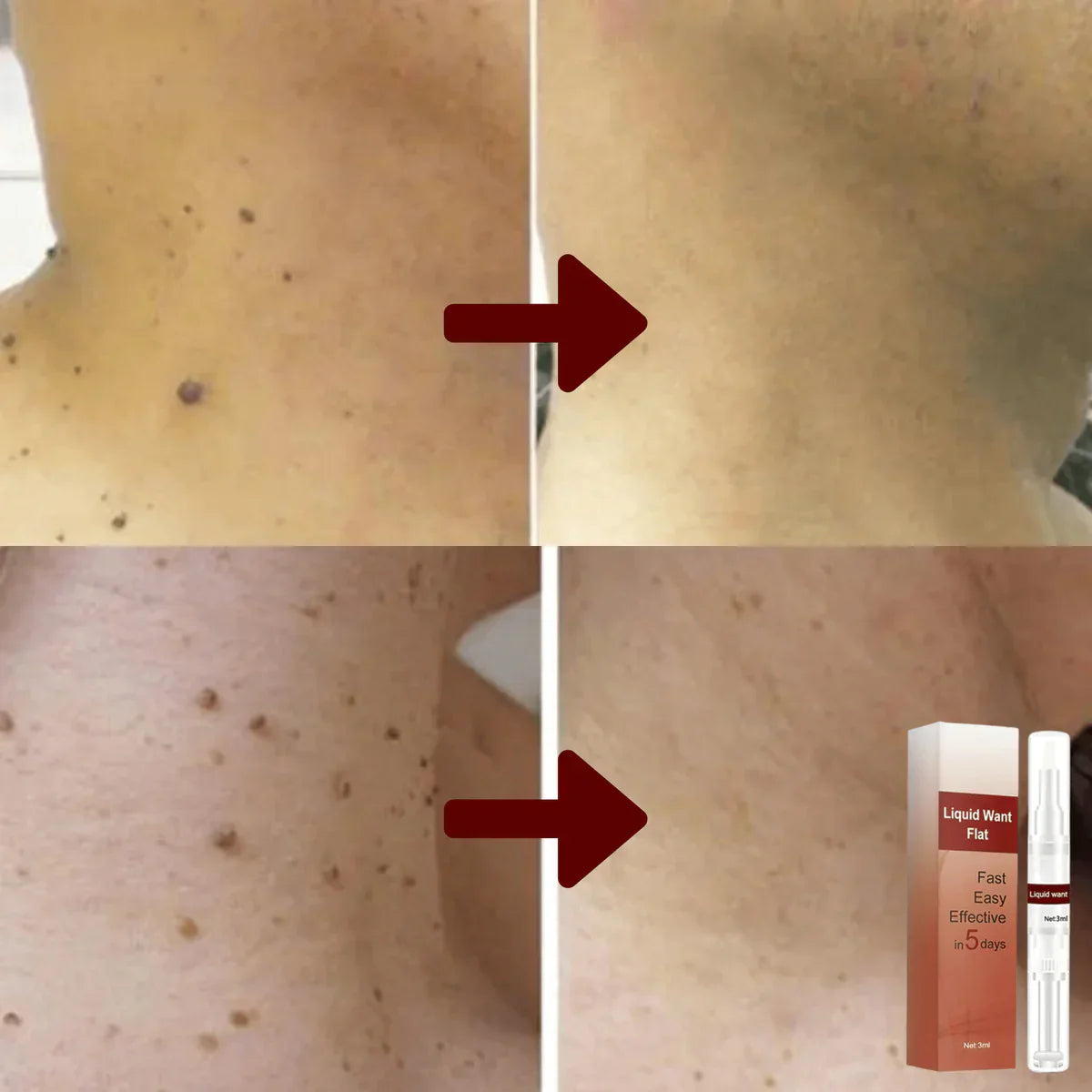 1+1 Free | MoleAway™ Painless Tag Removal