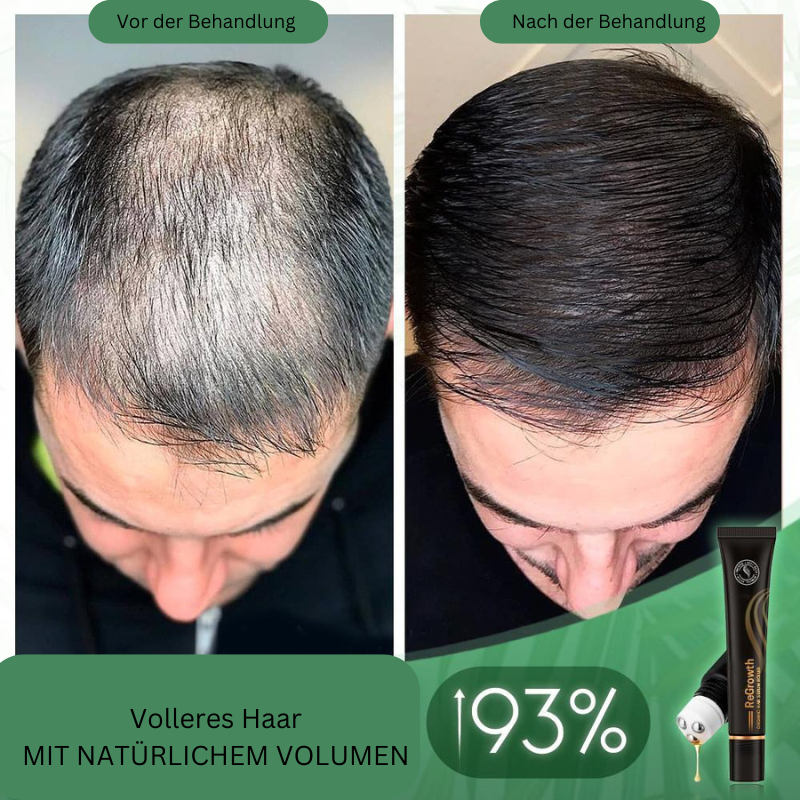 1+1 Free | GrowthRoller™ Stimulates Hair Growth