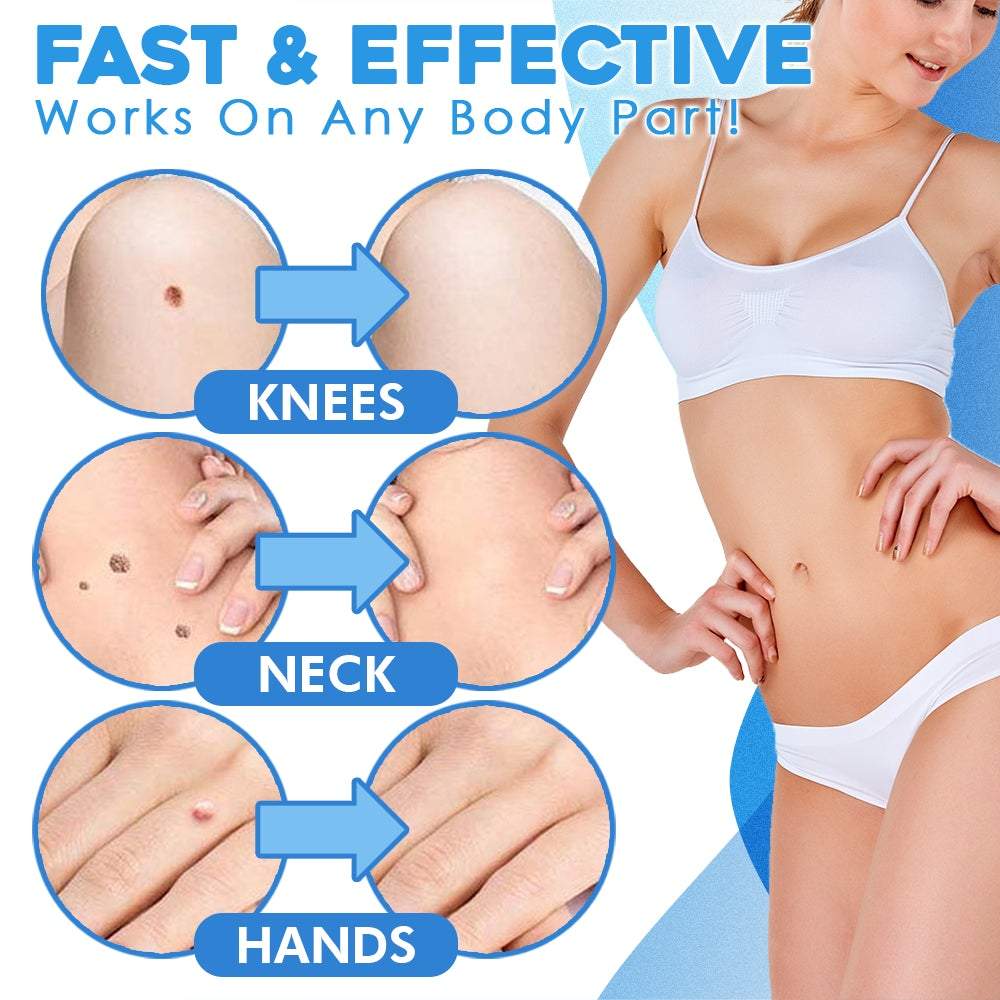 WartAway™ Targets Skin Growths