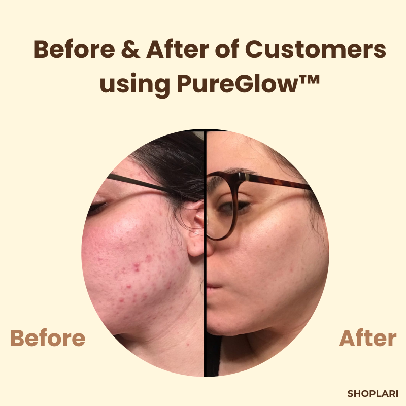 1+1 Free | PureSkin™ Complexion Repair Solution